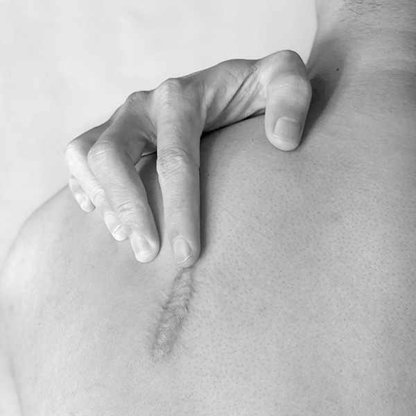 Best Scar Revision in Montclair, NJ | Dr. Caroline Szpalski