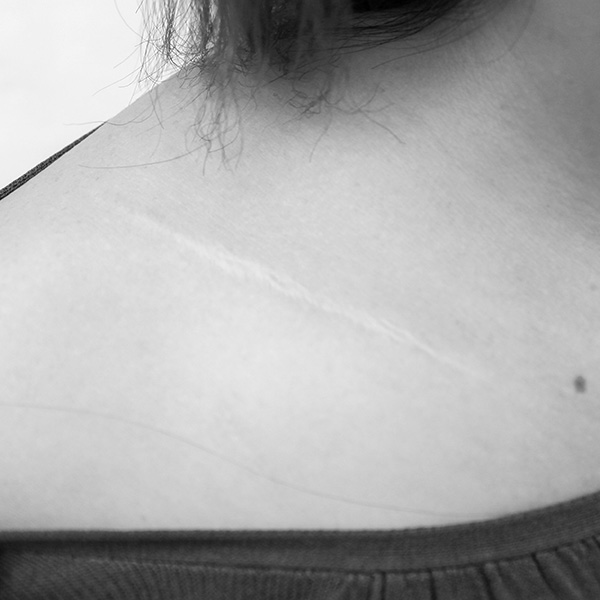 Best Scar Revision in Montclair, NJ | Dr. Caroline Szpalski